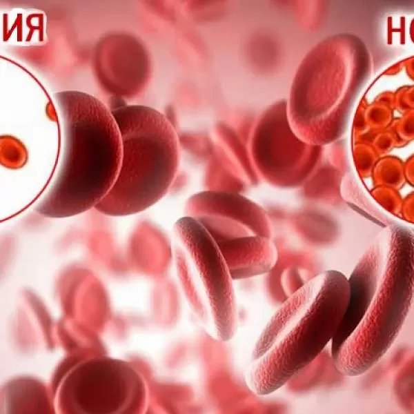 Анемия: что делать?